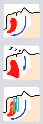 いびき・睡眠時無呼吸症候群とスリープスプリント